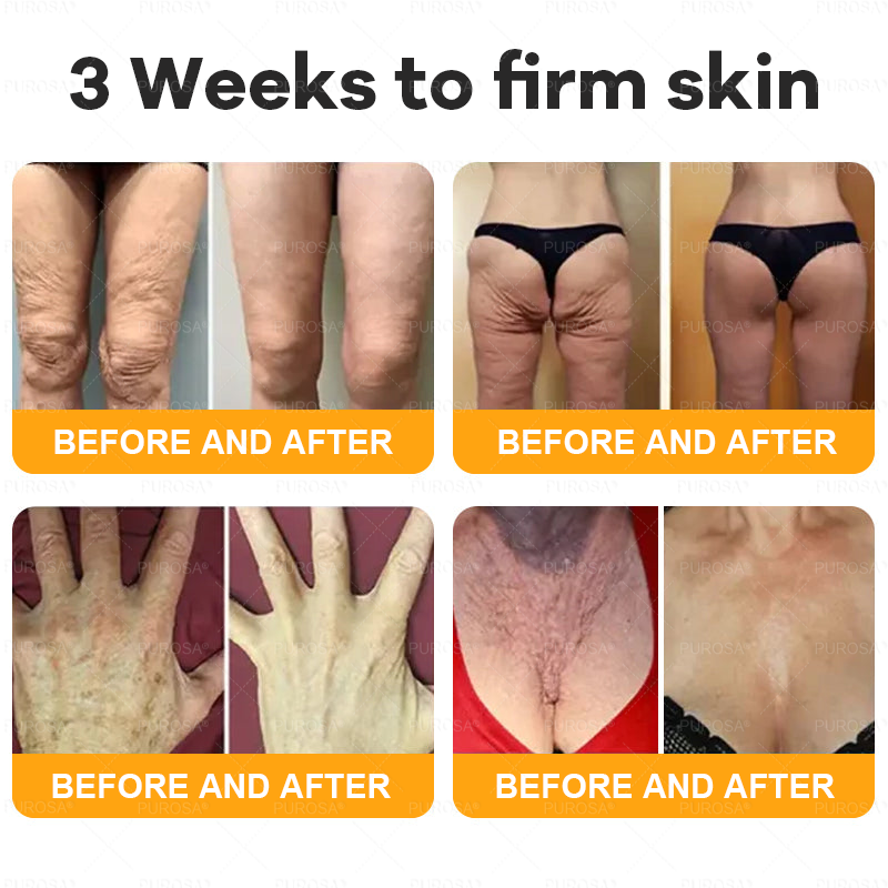 ✅✅Official Store:Made and Shipped from USA ✨ PUROSA® Bee Venom Skin Restoration Cream 🔥 LAST DAY 80% OFF